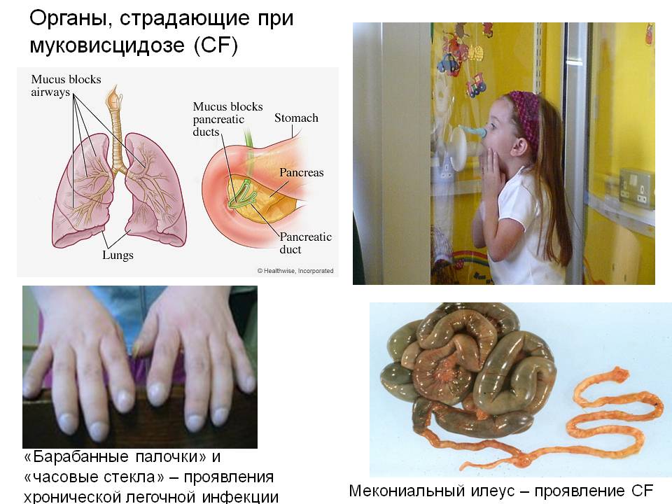Симптомы муковисцидоза
