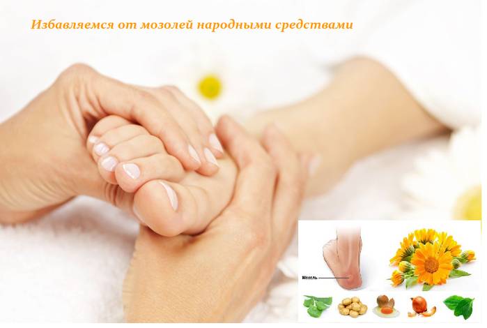 Лечение мозолей при помощи средств народной медицины