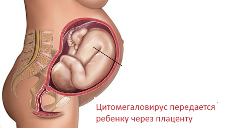 1420976448_citomegalovirus-3