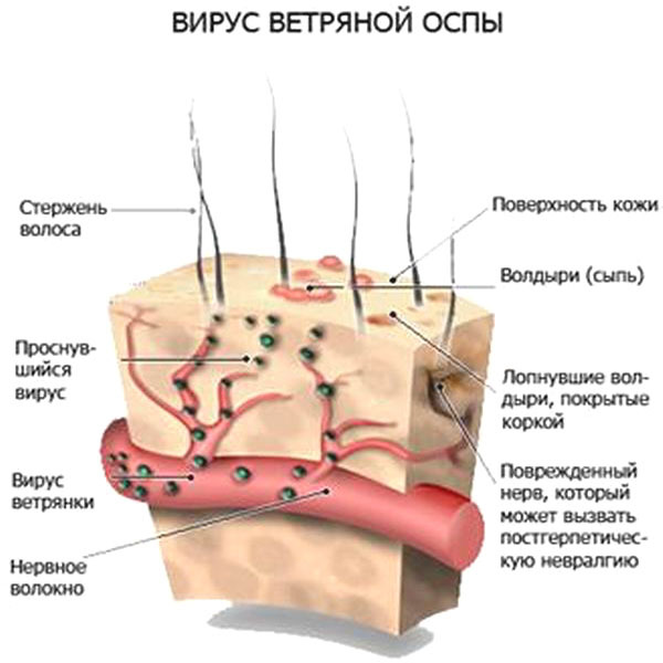 1442528611_vetryanka-u-detey-simptomy-lechenie-foto-4