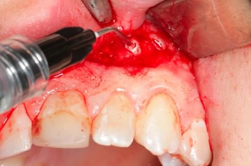 periodontit