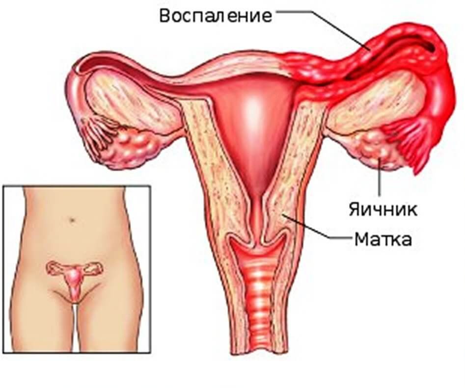 endometrit