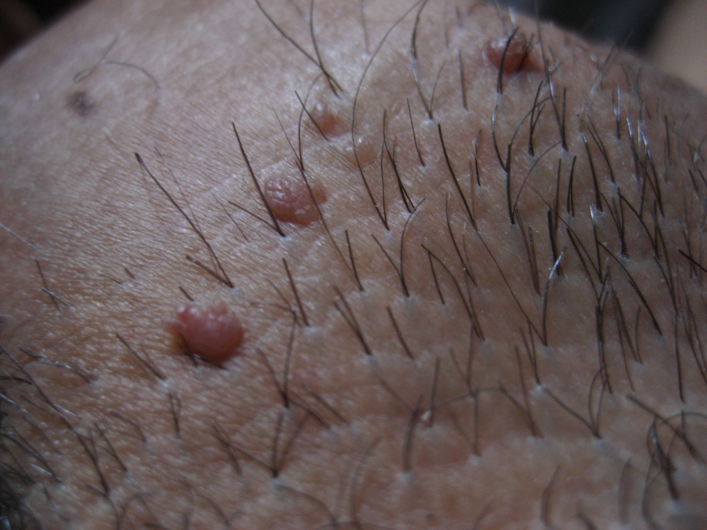 papiloma