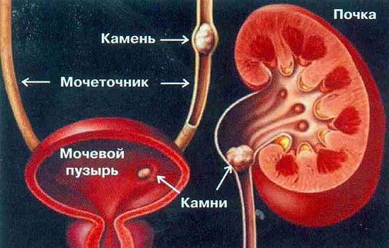 Мочекаменная болезнь