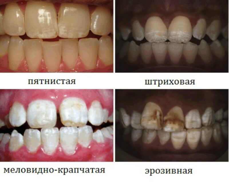 fluoroz