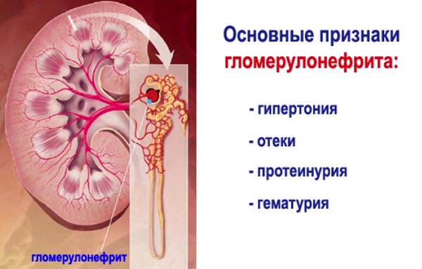 Гломерулонефрит