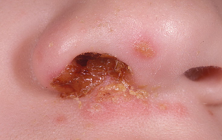 strep
