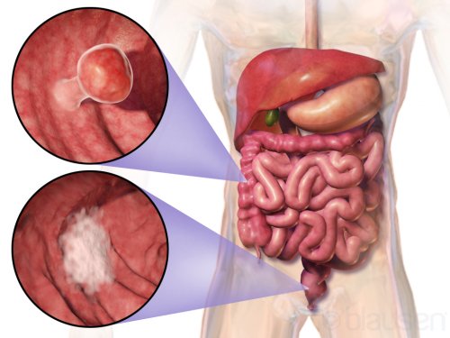 Colorectal