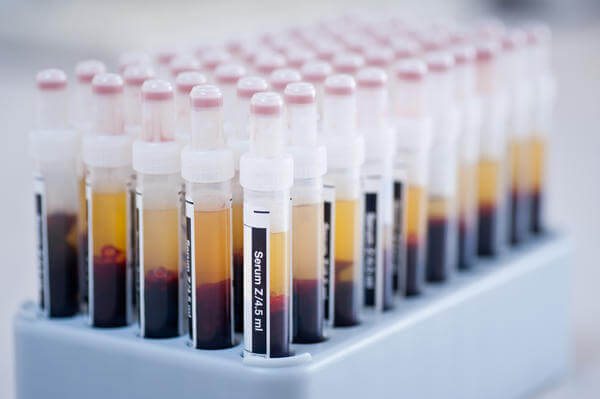 dyslipidemia