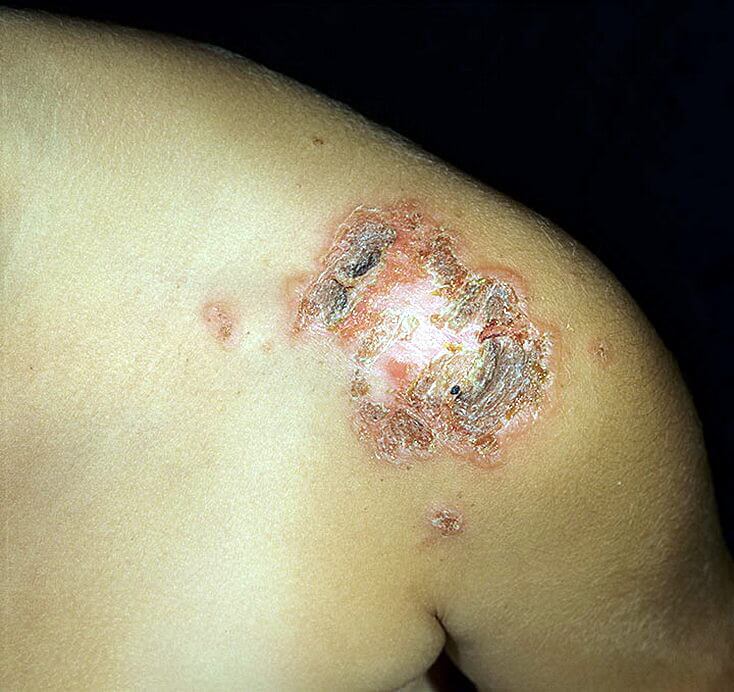 Ecthyma