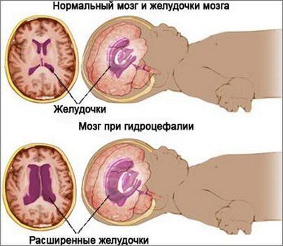 Гидроцефалия плода
