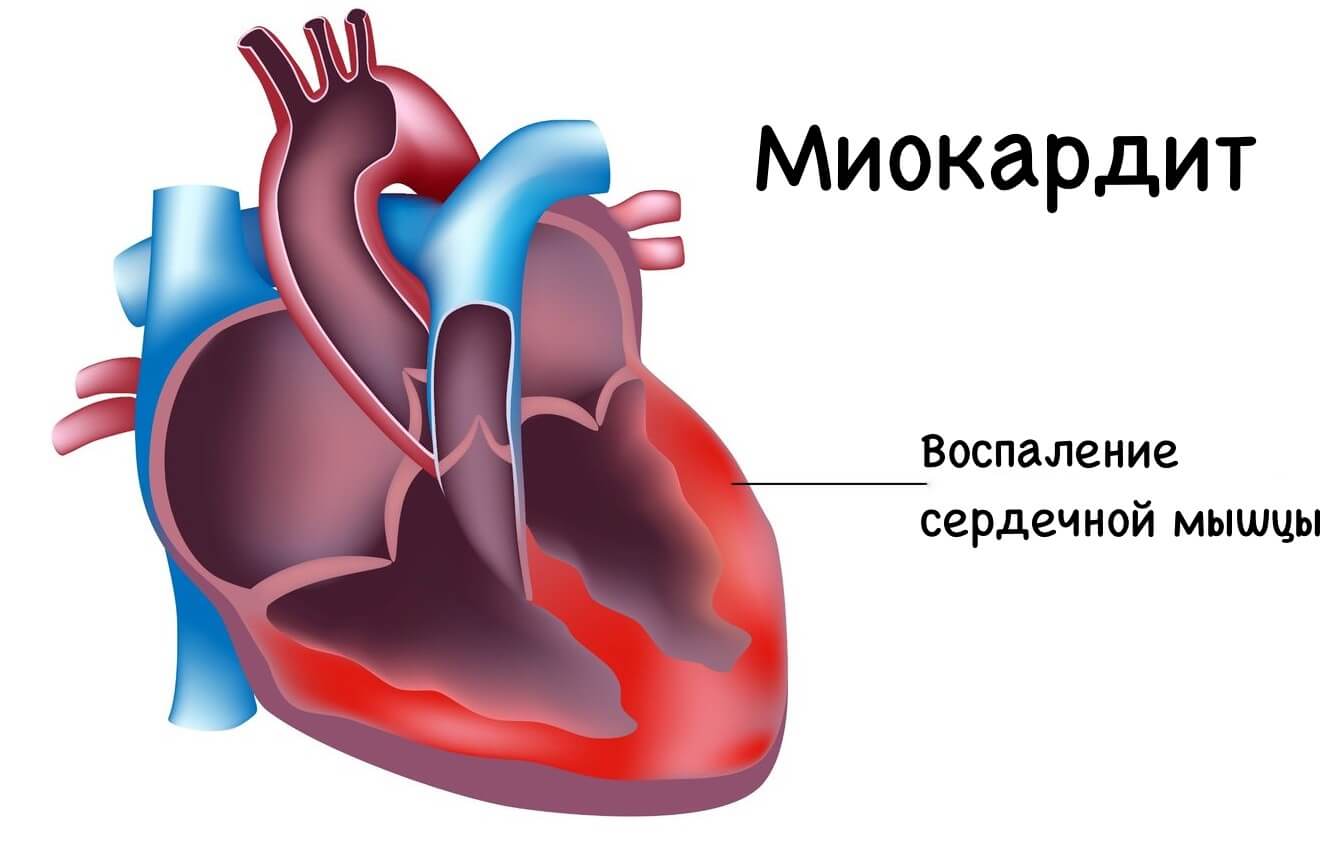 miokardit