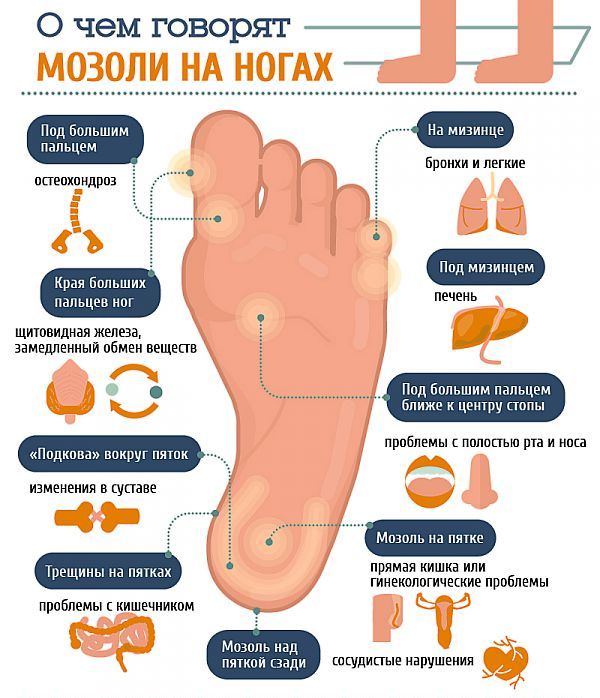 Мозоли