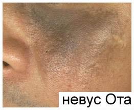 Невус Оты