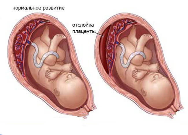 Normalnoe-razvitie-i-otslojka-platsenty (1)