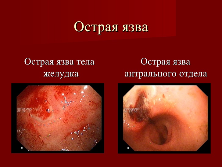Острая-язва