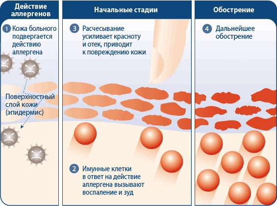Причины развития аллергического дерматита