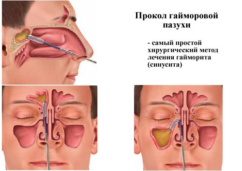 Как лечить гайморит в домашних условиях