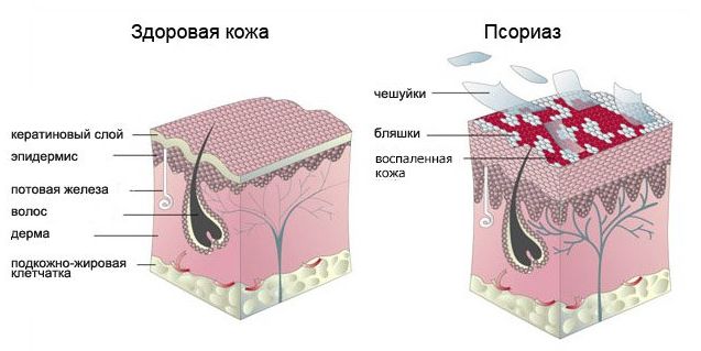 Псориаз