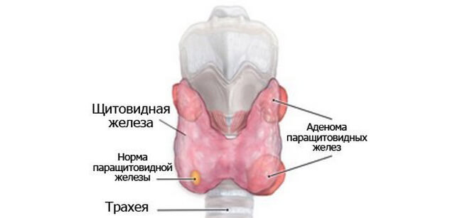 adenoma-parashchitovidnykh-zhelez