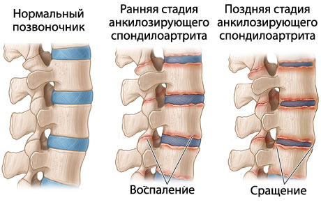 Симптомы анкилозирующего спондилоартрита