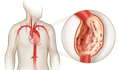 aorta