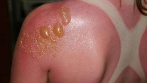 bulleznyj-dermatit-3