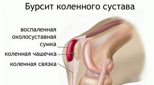 Симптомы бурсита