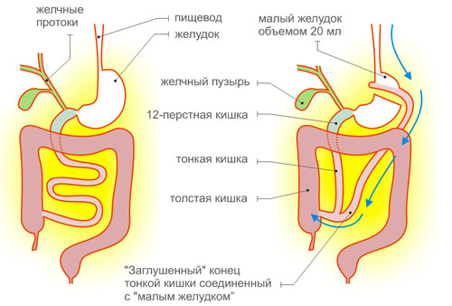 bypass