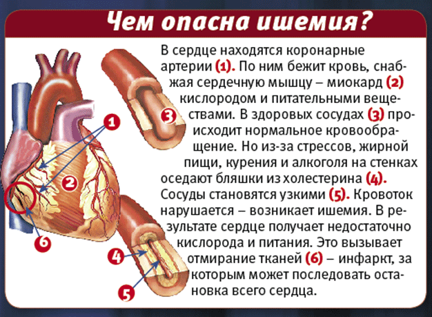 Внезапная сердечная смерть