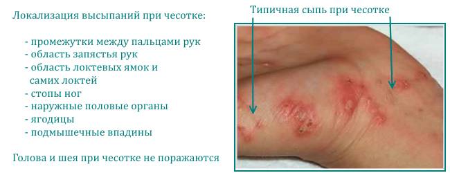 chesotka-3