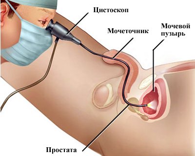 cistoskopija