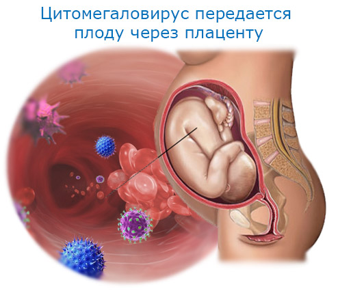 citomegavirus