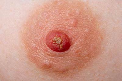 cracked_nipples