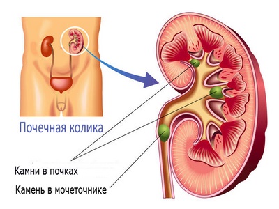 Лечение камней в почках