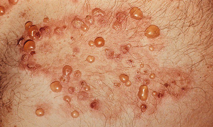dermatit-diuringa-734x436