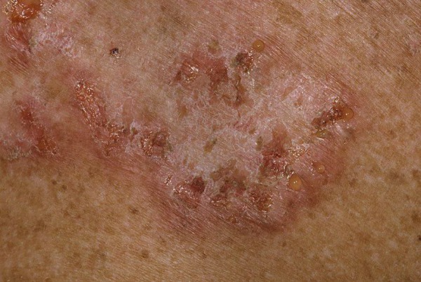 dermatoz_2-600x402