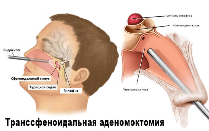 endoskopicheskaya-transsfenoidalnaya-adenomektomiya