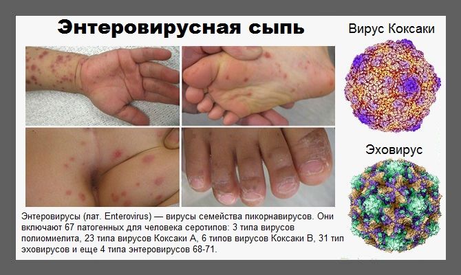 Энтеровирусная инфекция: симптомы