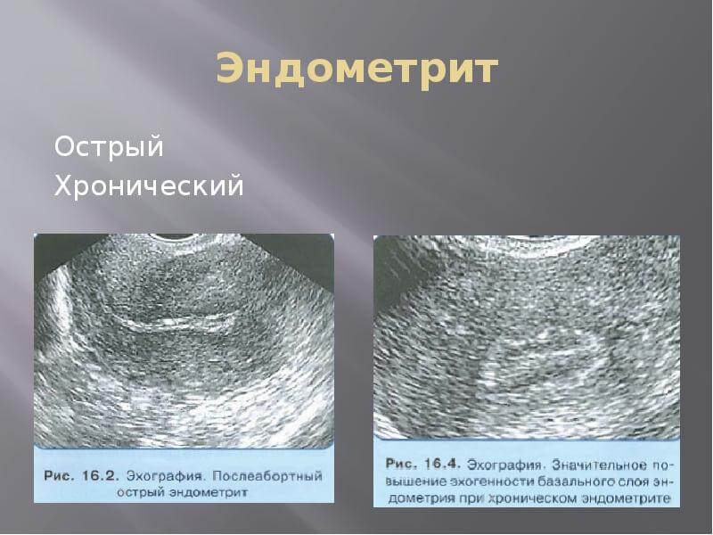 endometrit ostryi