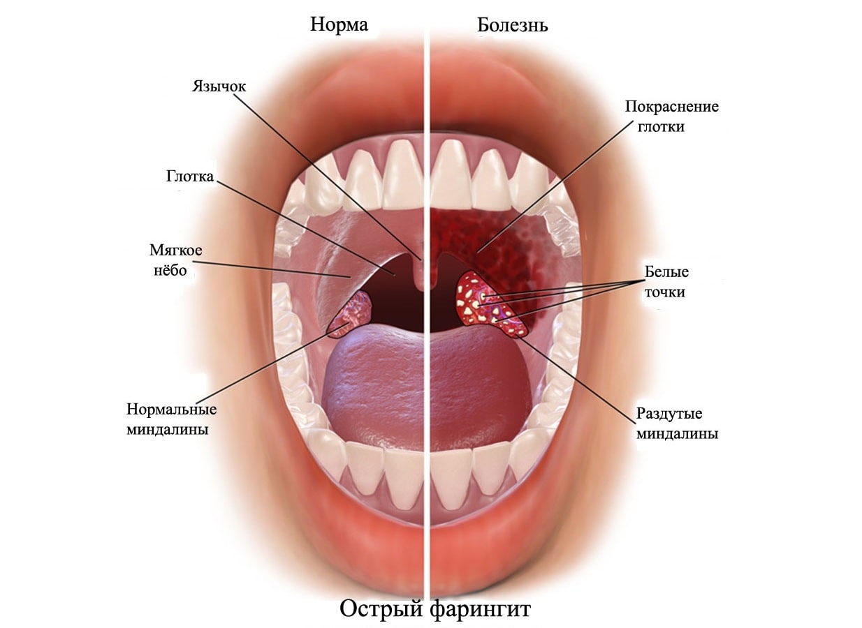 симптомы фарингита