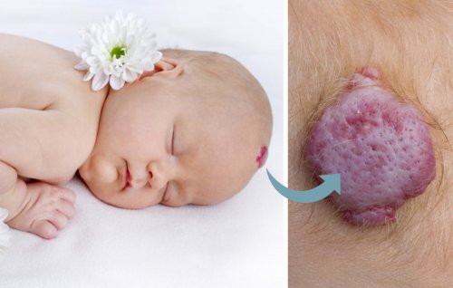 gemangioma