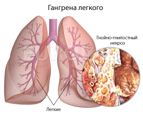 gangrena