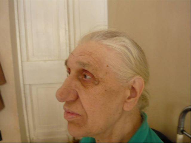 akromegalia