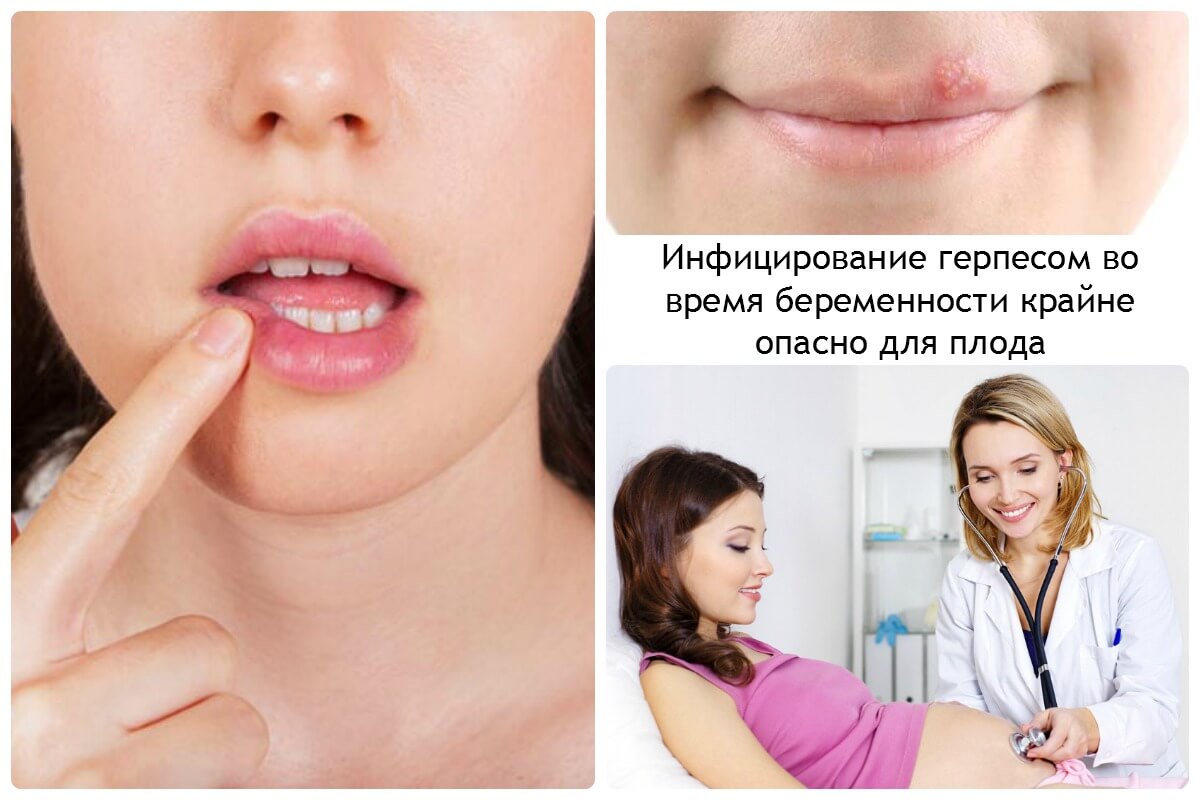 infecirovanie gerpes