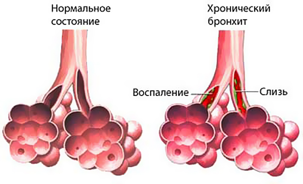 khronicheskij-bronkhit
