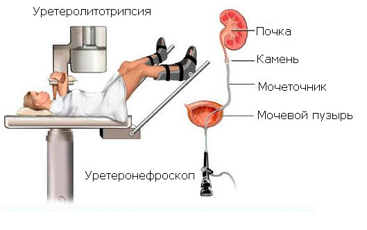 kontaktnaya-transuretralnaya-ureterolitotripsiya