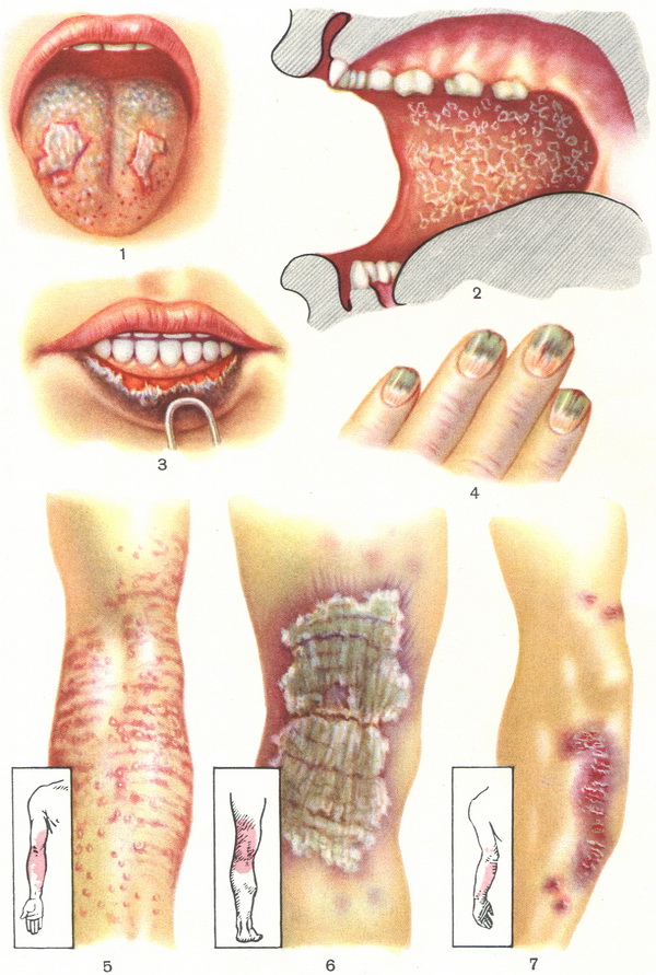 lichen-ruber-planus