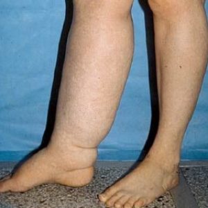 lymphedema
