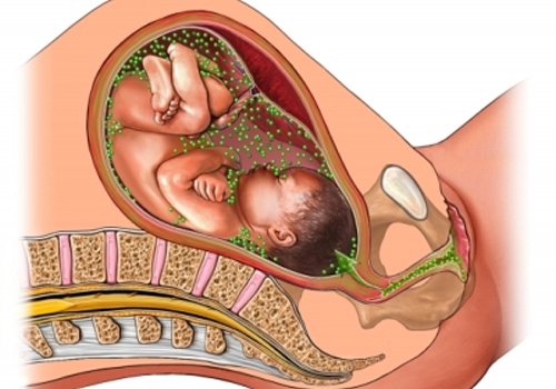 miscarriage2